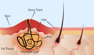 Pilonidal Cyst