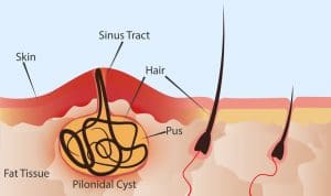 pilonidal cyst treatment