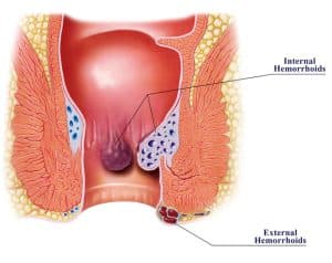 Bleeding Internal Hemorrhoids Treatment