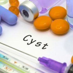 Understanding pilonidal cysts and their impact