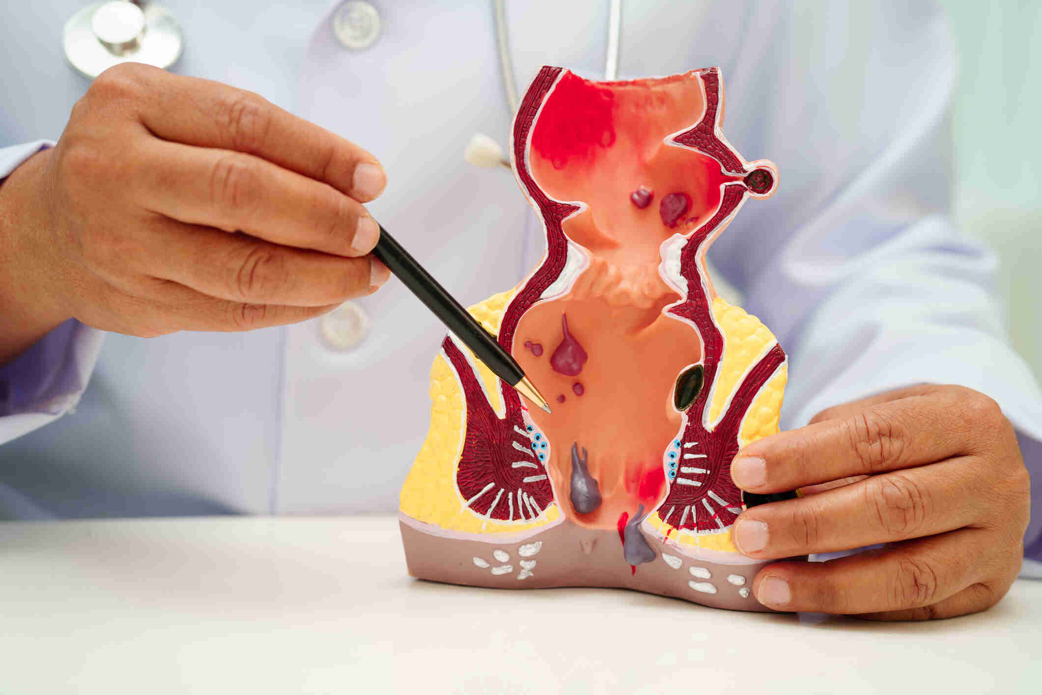 Asian doctor with rectum and hemorrhoid human anatomy model at hospital, inflamed vascular structure. Asian doctor with rectum and hemorrhoid human anatomy model at hospital, inflamed vascular structure.
