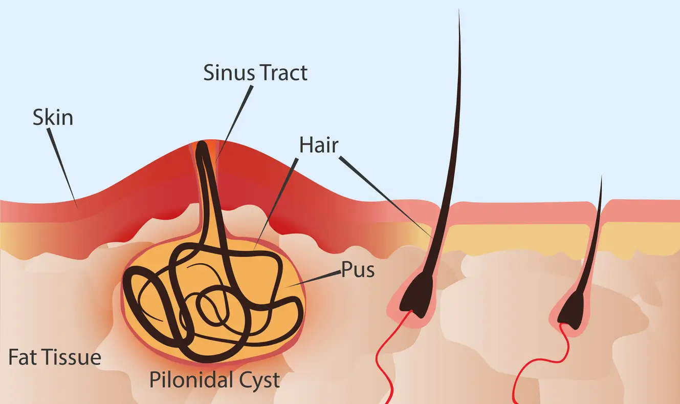 What Surgery Options Exist for Pilonidal Cysts