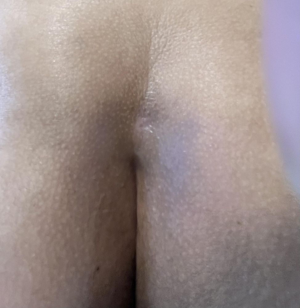 Casandara preprocedure Pre-Treatment-600x797