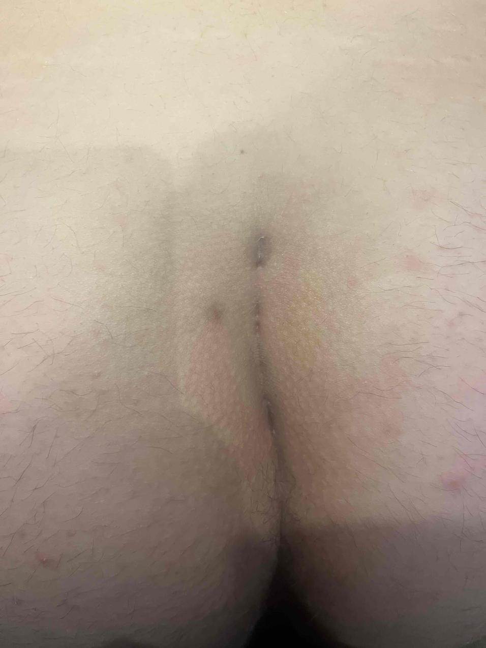 Colby Week 13 Pre-Treatment-600x797