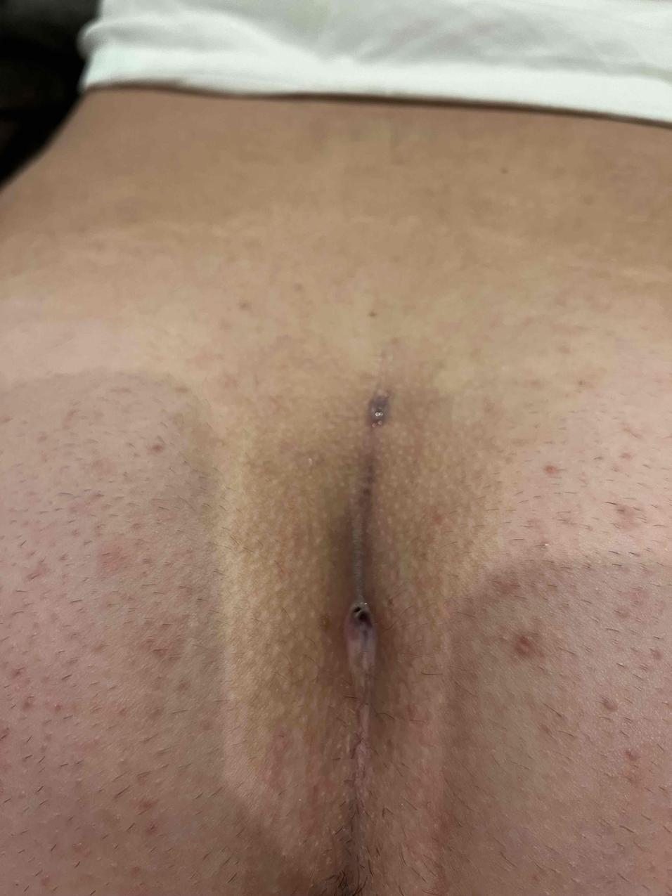 Colby Week 3 Pre-Treatment-600x797