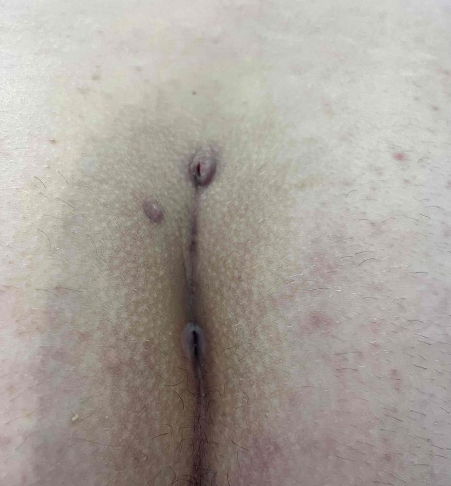 Colby Week 7 Pre-Treatment-600x797