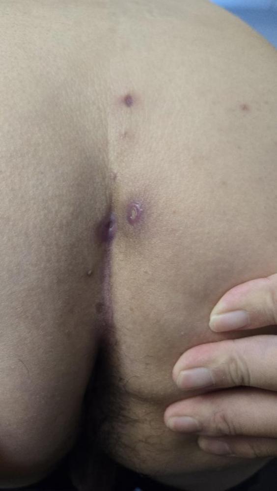 Pateint 3 week 3 Pre-Treatment-600x797