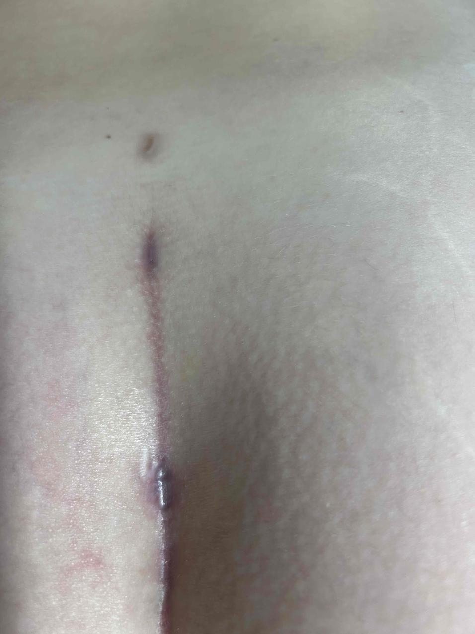 Patient 1 week 14 Pre-Treatment-600x797