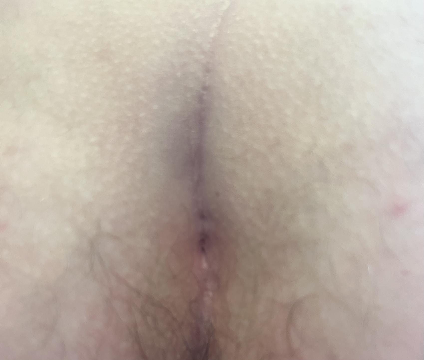 Patient 2 Pre Procedure Pre-Treatment-600x797
