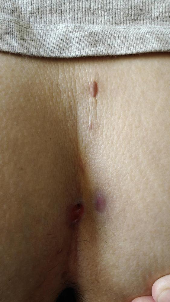 Patient 3 Week 7 Pre-Treatment-600x797