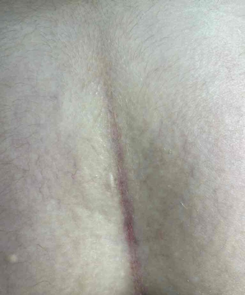 Tamara Pre Procedure Pre-Treatment-600x797