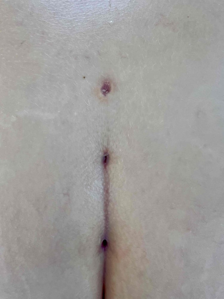 Patient Week 3 Pre-Treatment-600x797