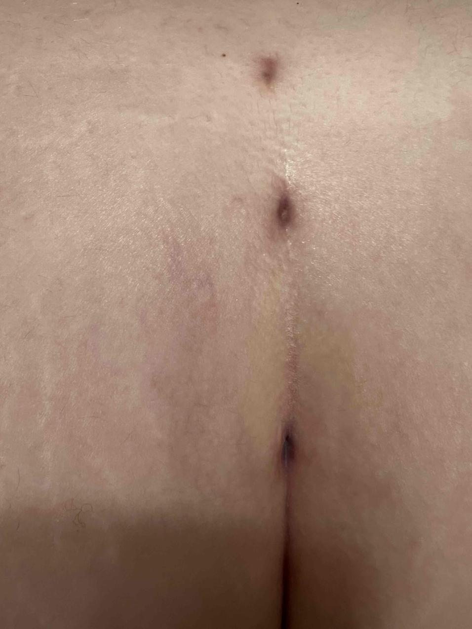 Patient Week 7 Pre-Treatment-600x797