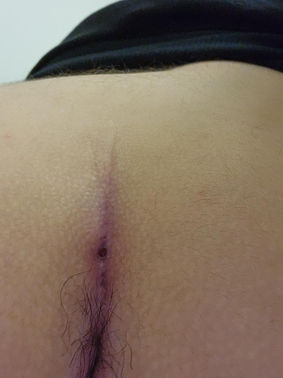 patient 5 pre Pre-Treatment-600x797