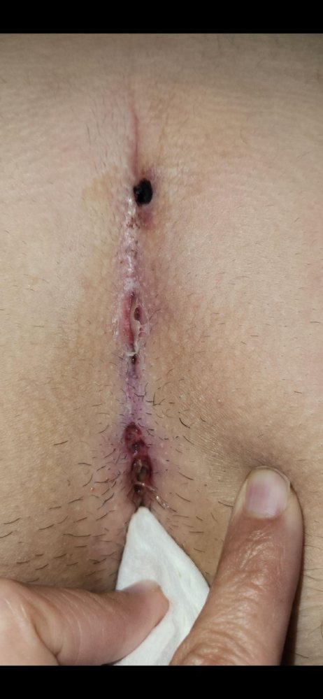 patient 6 week 1 Pre-Treatment-600x797