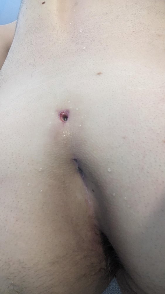 patient 6 week 11 Pre-Treatment-600x797