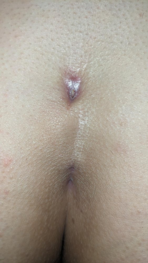 patient 6 week 5 Pre-Treatment-600x797